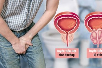 Chữa dứt điểm viêm tuyến tiền liệt sau 3 năm dài cực khổ