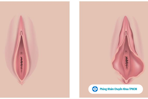 Hình ảnh minh họa âm đạo giãn rộng ở nữ giới