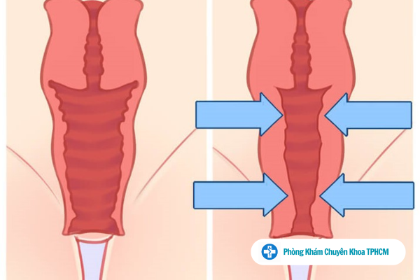 Thu hẹp âm đạo được thực hiện bằng nhiều phương pháp hiện nay